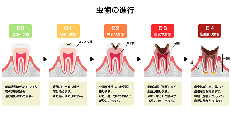 痛みが無くても虫歯が進行している場合もあります