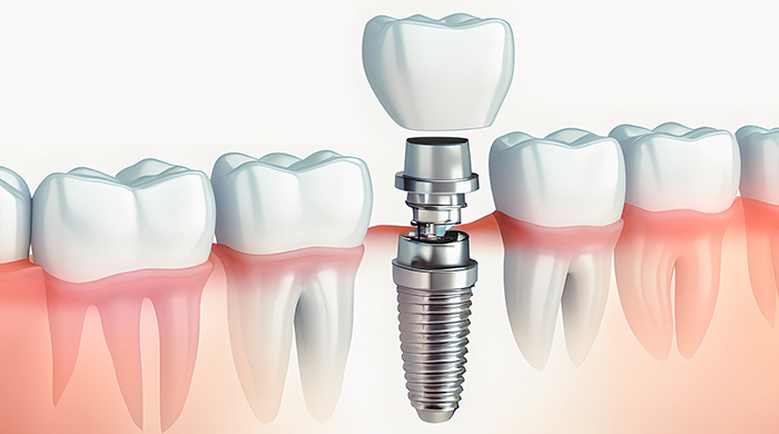 他の歯に負担をかけない安全なインプラント治療