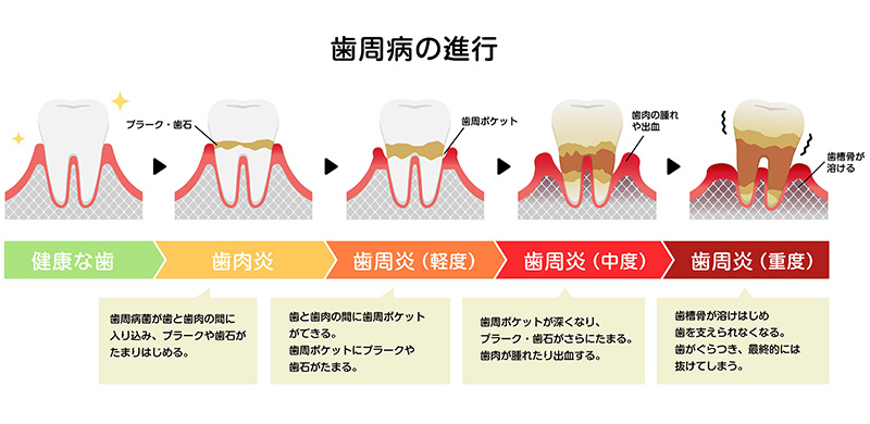 このような症状は歯周病かもしれません